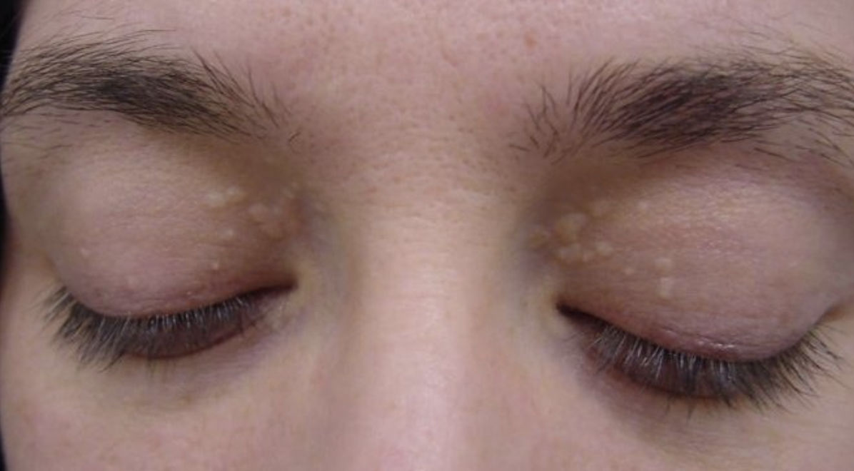 U vàng hay u mí mắt là tình trạng lắng đọng mô mỡ dưới da, báo hiệu trước tình trạng mỡ máu cao