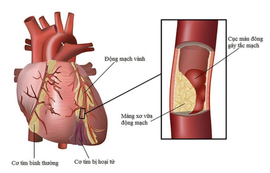 Hình ảnh tắc nghẽn mạch vành