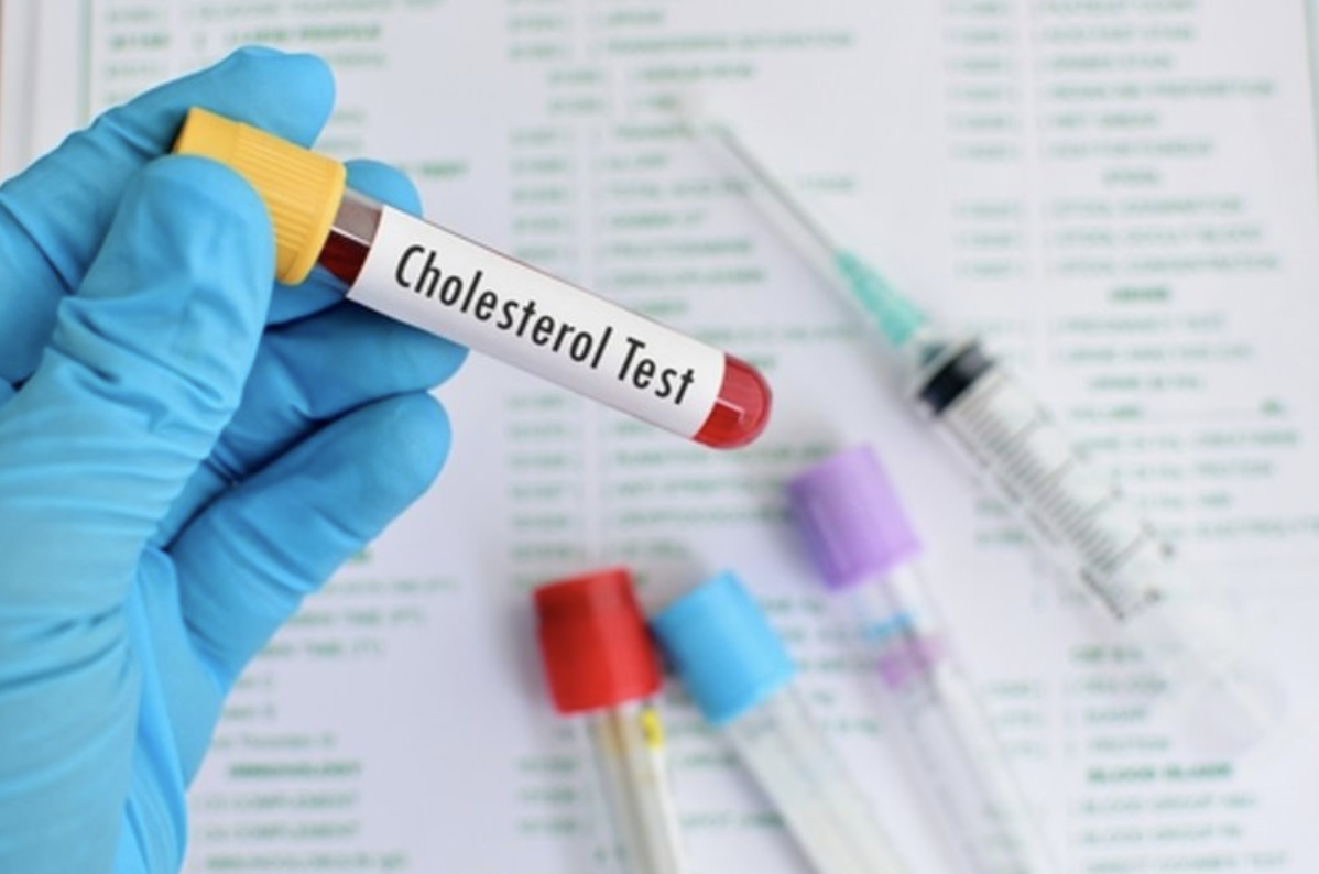 Chỉ số cholesterol toàn phần giúp đánh giá nguy cơ biến chứng tim mạch
