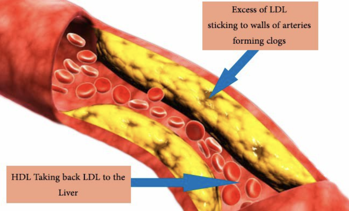 Chỉ số LDL cao làm giảm lưu thông máu