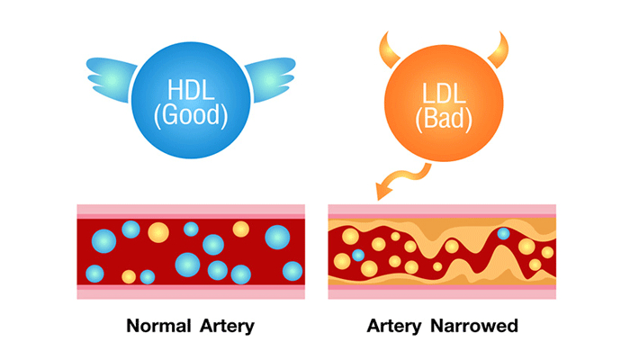 HDL Cholesterol ( là Cholesterol tốt) - LDL Cholesterol (là Cholesterol xấu)