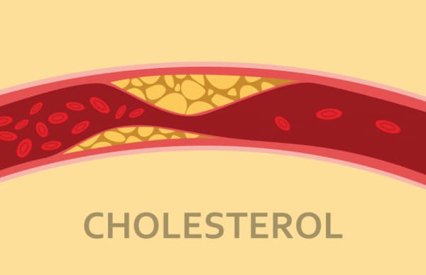 Cholesterol là gì? Có mấy loại Cholesterol?