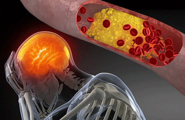 Cholesterol cao cực kì nguy hiểm vì nó có thể kéo theo nhiều căn bệnh, biến chứng nguy hiểm khác.