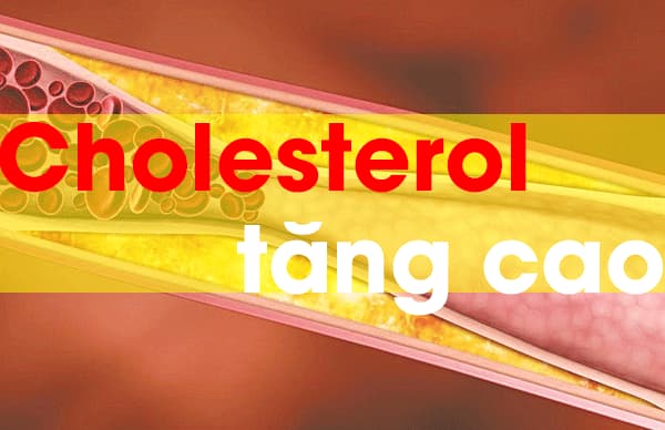 Cholesterol cao có chữa được không?