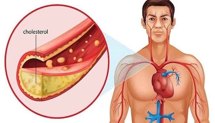 Dấu hiệu, triệu chứng tăng Cholesterol trong máu