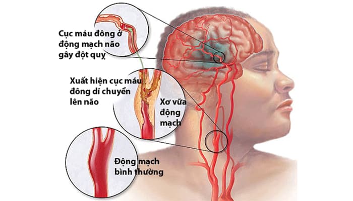 Cục máu đông ở động mạch não là nguyên nhân gây đột quỵ