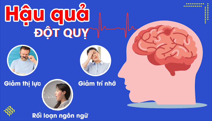 Đột quỵ não rất nguy hiểm và nó để lại những hậu quả nghiệm trọng khi bị mắc phải sau này