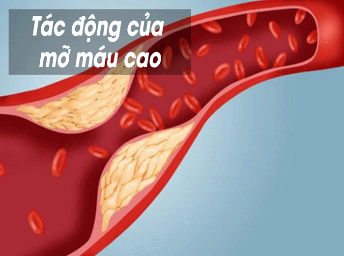 Khi bị mỡ máu cao, bệnh mỡ máu hay rối loạn lipid máu, thì nồng độ Cholesterol (Lipoprotein-LDL) hoặc chất béo trung tính hoặc cả hai sẽ ở mức cao hơn bình thường