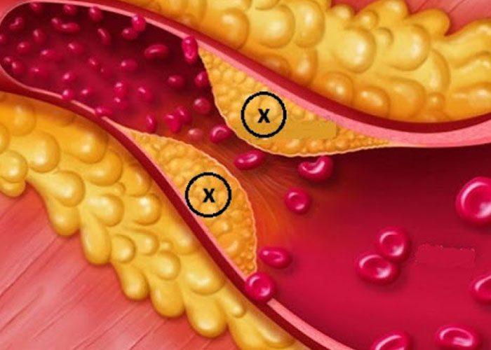 Vai trò của cholesterol và các thành phần của nó trong đột quỵ nguyên phát (nghĩa là phòng ngừa đột quỵ chính)