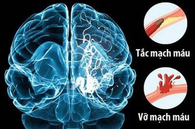 Phình mạch và động mạch bị tắc có thể là nguyên nhân của bệnh mạch máu não