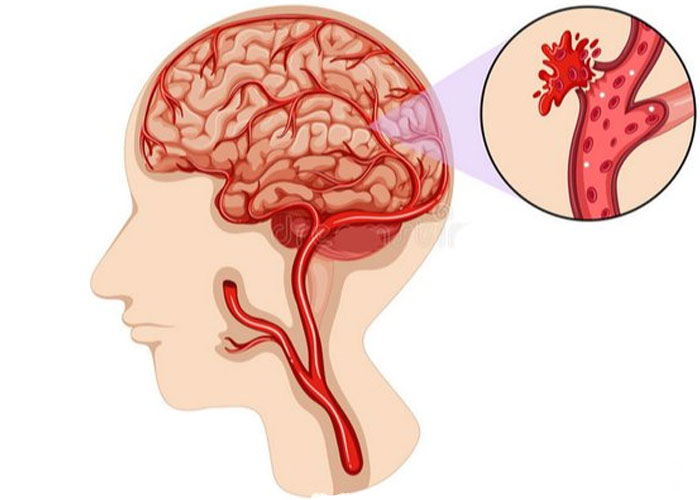 Huyết áp cao có thể gây vỡ các nhánh mạch máu trong não
