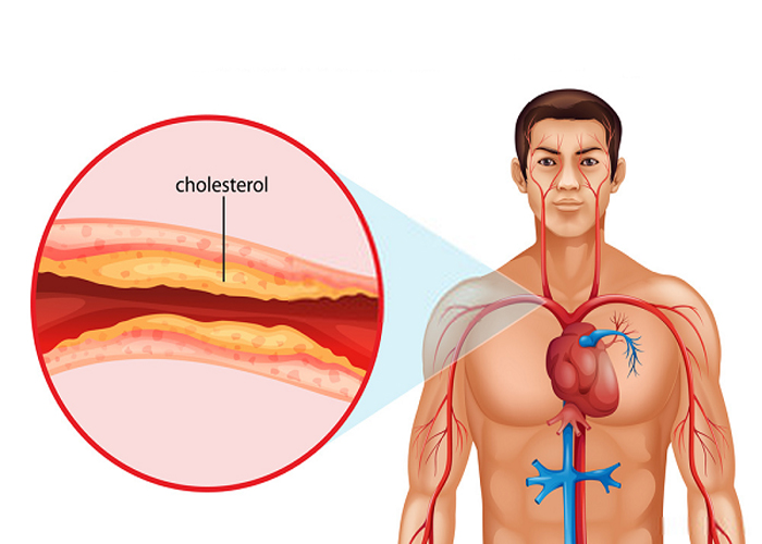 Cholesterol là một chất béo dạng sáp được gọi là lipid