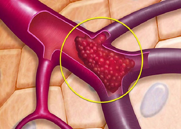 Huyết khối hình thành và gây tắc nghẽn lòng mạch là một trong những biến chứng khi phẫu thuật