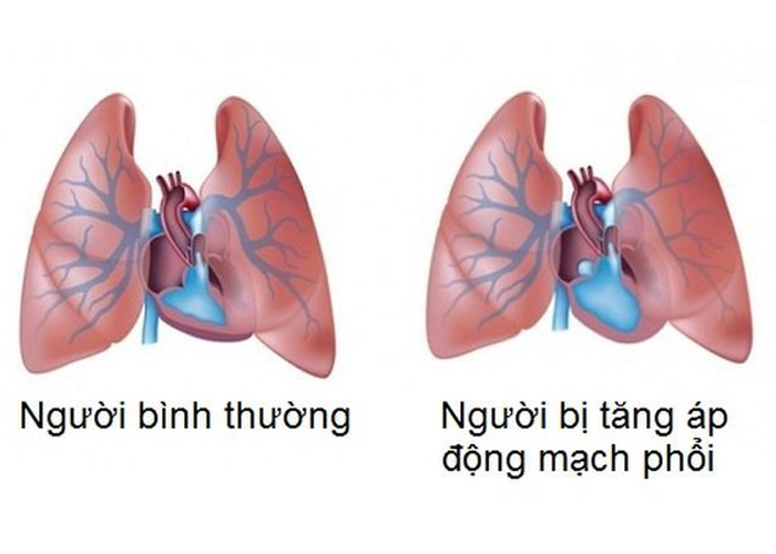 Tăng áp động mạch phổi là một loại tăng huyết áp